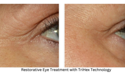 Restorative Eye Treatment with TriHex Technology